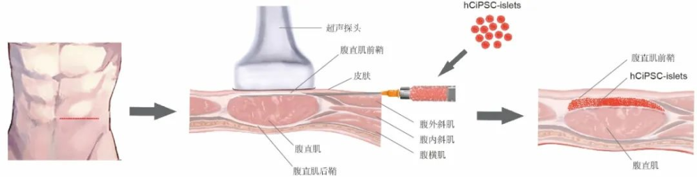 事關(guān)糖尿病治療，我國科學(xué)家取得突破